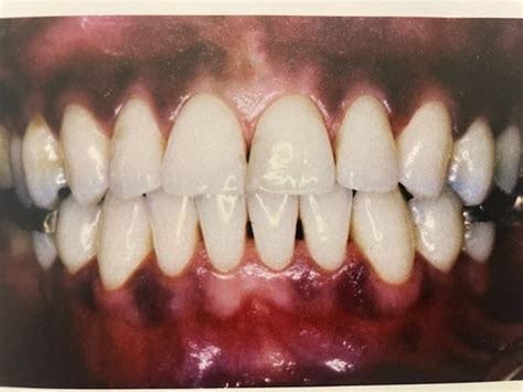 Gingival descriptor images Flashcards | Quizlet