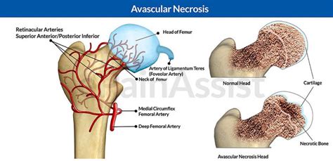 Avascular Necrosis | A+ Orthopaedics & Sports Med Center|New Delhi