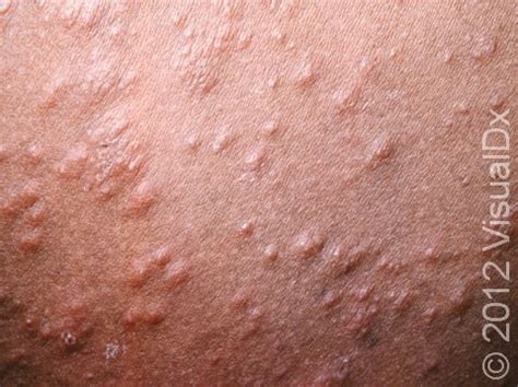 Heat Rash: Pictures, Symptoms, Causes, Treatment, Home, 52% OFF