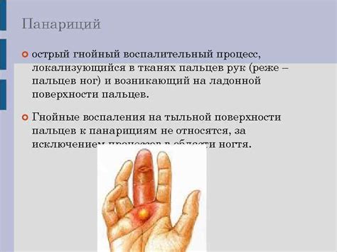 Панариций Панариций острый гнойный воспалительный процесс локализующийся