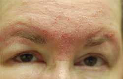 Periorbital Edema Hypothyroidism