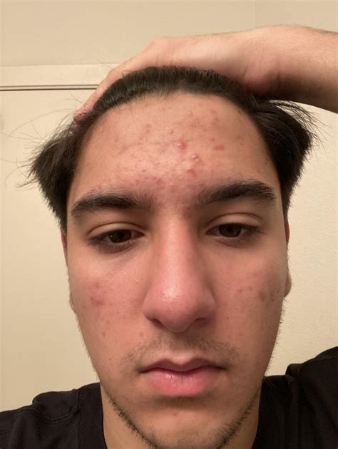 Forehead acne [acne] : r/SkincareAddiction