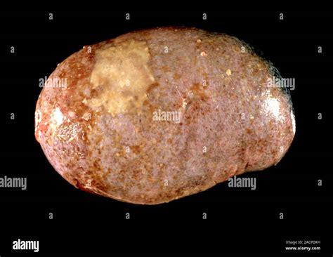 Waldenstrom's macroglobulinemia. Gross specimen of a spleen affected by ...