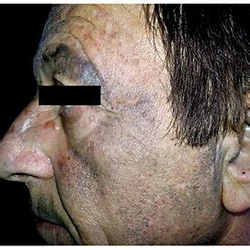 diffuse blue gray discoloration   face  scientific