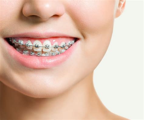 teeth braces service  fort mcmurray pyramid dental