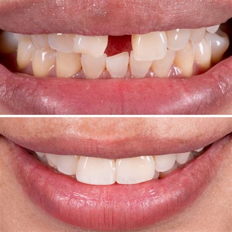 Direct Aesthetic Composite Restorations - CitySmile