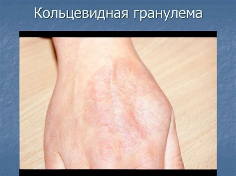 Дифференциальная диагностика высыпаний на лице - презентация онлайн