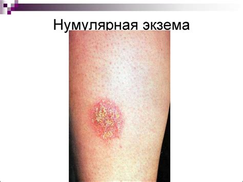 Аллергодерматозы. Дерматиты токсикодермии - презентация онлайн