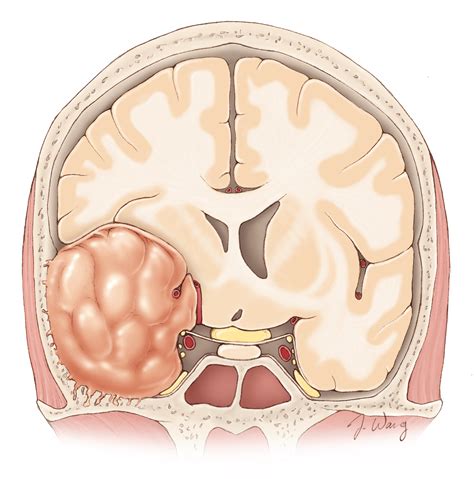 Meningioma And Radiosurgery at James Mansell blog