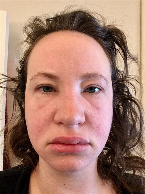 The Swell — Me, Myself & Lymphoma
