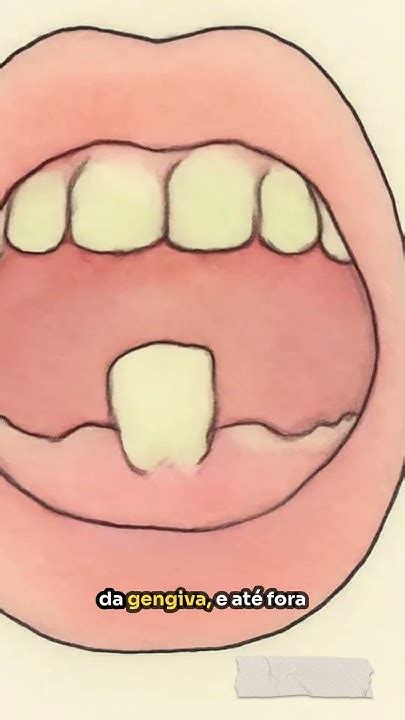 Dente No Céu Da Boca É Perigoso - Você sabia que dente pode nascer no céu da boca? #viralvideo # ...
