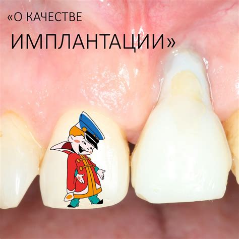 О качестве имплантации. — IMPLANT-IN.COM — дентальная имплантация ...