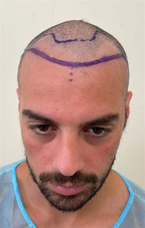 From Hair Loss to Hair Gain: Pierre's Experience