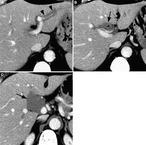 Non-Hodgkin lymphoma of the liver in a 45-year-old man. A... | Download ...