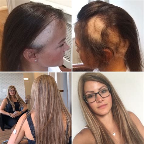 Hair Loss Treatment Updates at Kayla Chirnside blog