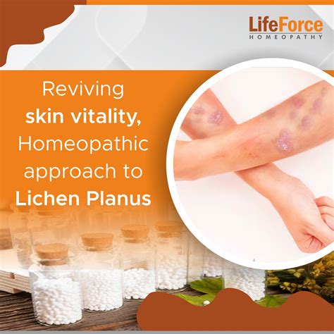 Lichen Planus Treatment | Reviving Skin Vitality with Homeopathy