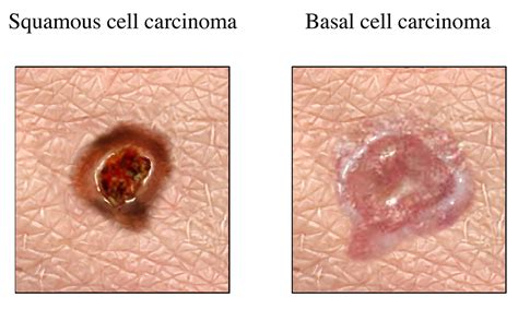 Squamous Cell Carcinoma Facts | City of Hope