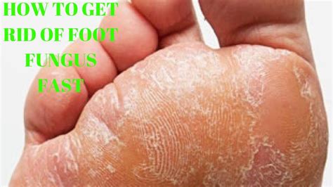 Feet Fungus