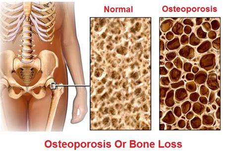 Nurse Health Guides : Osteoporosis: Causes, Signs-Symptoms, Diagnosis ...