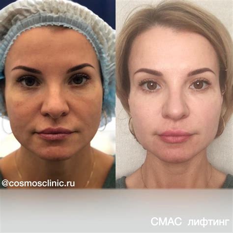Что такое миниабдоминопластика живота фото до и после