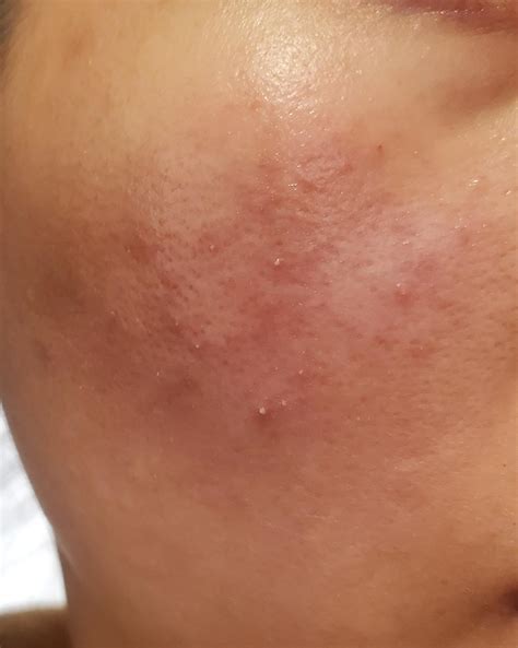 Bacterial Infection Face