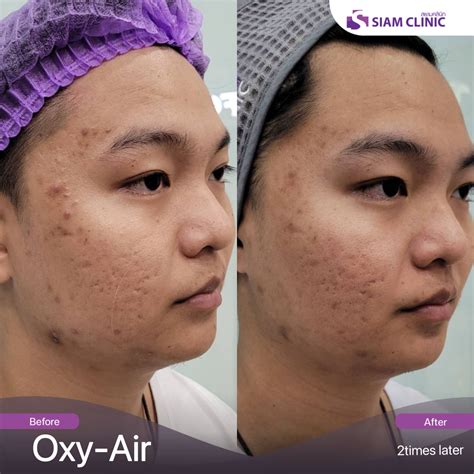 Acne Treatment Before and After Photos - Siam Clinic Thailand