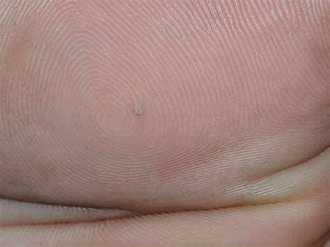 does this look like a wart? if so how do I treat it? : Warts