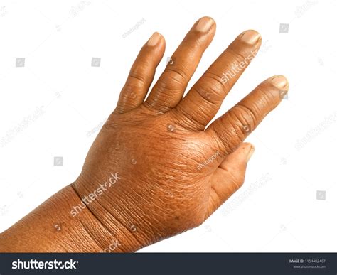 swollen hands images browse  stock  vectors