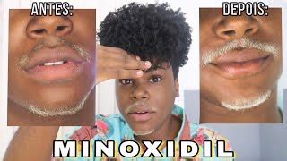 Antes E Depois Minoxidil - So Minoxidil Antes E Depois Minoxidil No Tratamento Da Queda De Cabelo