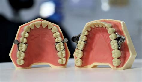 New Zealand researchers create weight-loss device that locks jaws ...