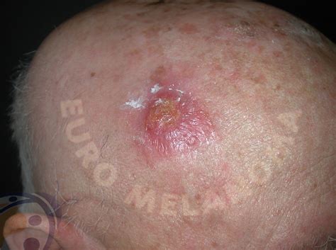 Types of skin cancer - Spinaliom - Euromelanoma