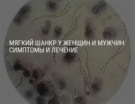 Мягкий шанкр у женщин и мужчин: симптомы, лечение и профилактика