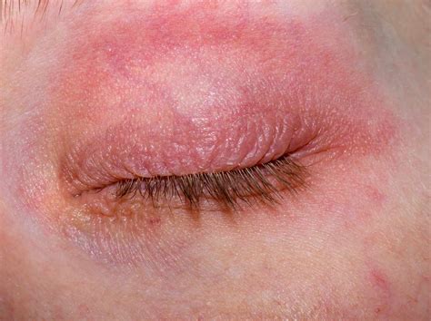 Rash Around Eyes: Causes, Symptoms, and Treatment