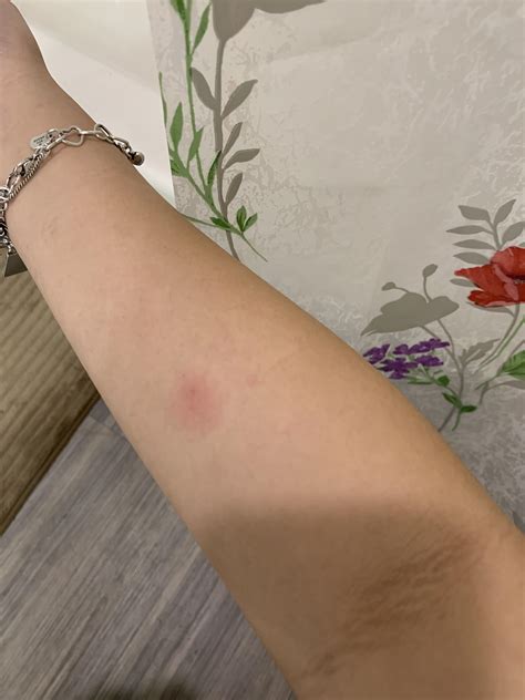 Medical guides explain the meaning of photos of a positive tb test 19