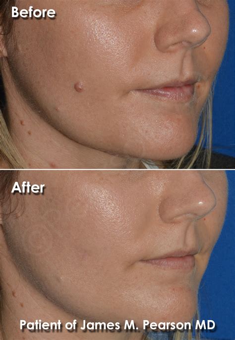 Mole Removal Scar Treatment at Kathy Foley blog