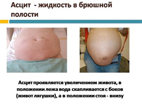 Осложнения цирроза печени: как умирают и симптомы перед смертью