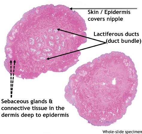 An Analysis of Nipple Enhancement at Breast MRI with Radiologic ...