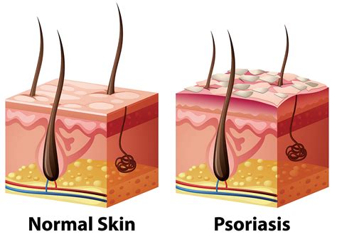 understanding psoriasis      manage