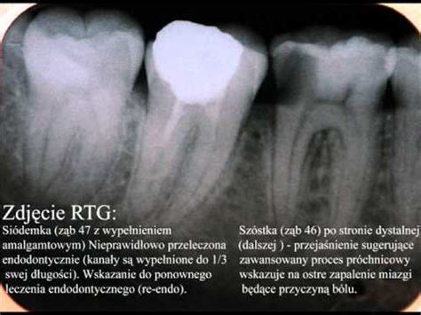 Na czym polega leczenie endodontyczne (kanałowe) zęba? - YouTube