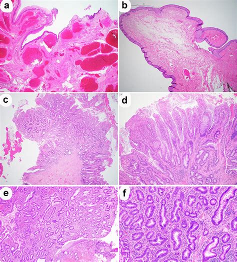 A Review and Update on Epithelial Tumors of the Anal Canal