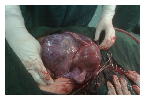 Placenta percreta invading broad ligament and parametrium in a woman ...