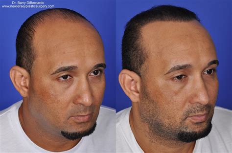 Hair Transplant Before And After