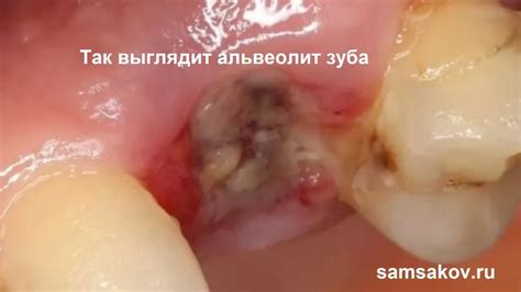 Альвеолит зуба: причины, симптомы и лечение | Альянс бьюти стоматологов ...