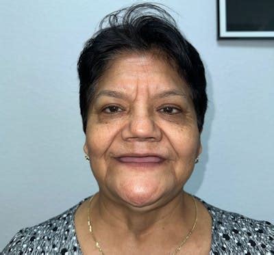 Zygomatic Implants Before & After Photos | SmileOnImplants Dental Center