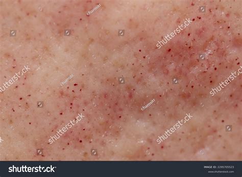 2 Pico Face Treatment Images, Stock Photos & Vectors | Shutterstock