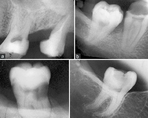 maxillary  molar anatomy  permanent maxillary  mandibular