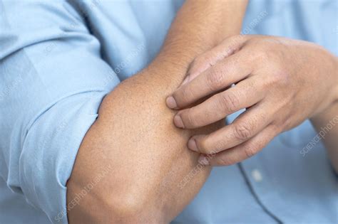 man scratching  arm stock image  science photo library