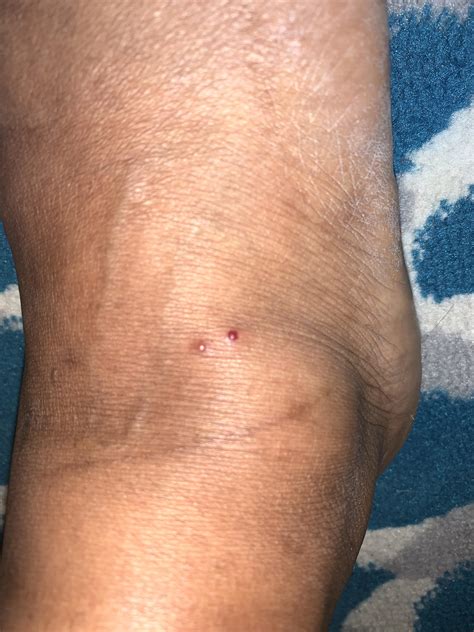 Help. Does this look like a spider bite? Burning sensation and hurts to ...