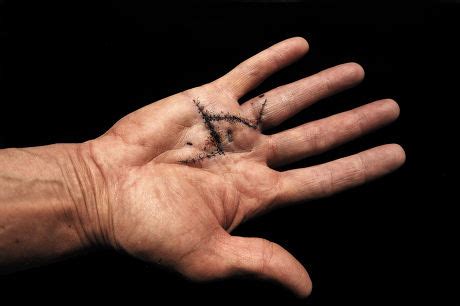 36 Contracture Stock Pictures, Editorial Images and Stock Photos ...