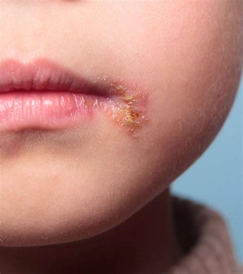 skin rashes  children   treatment